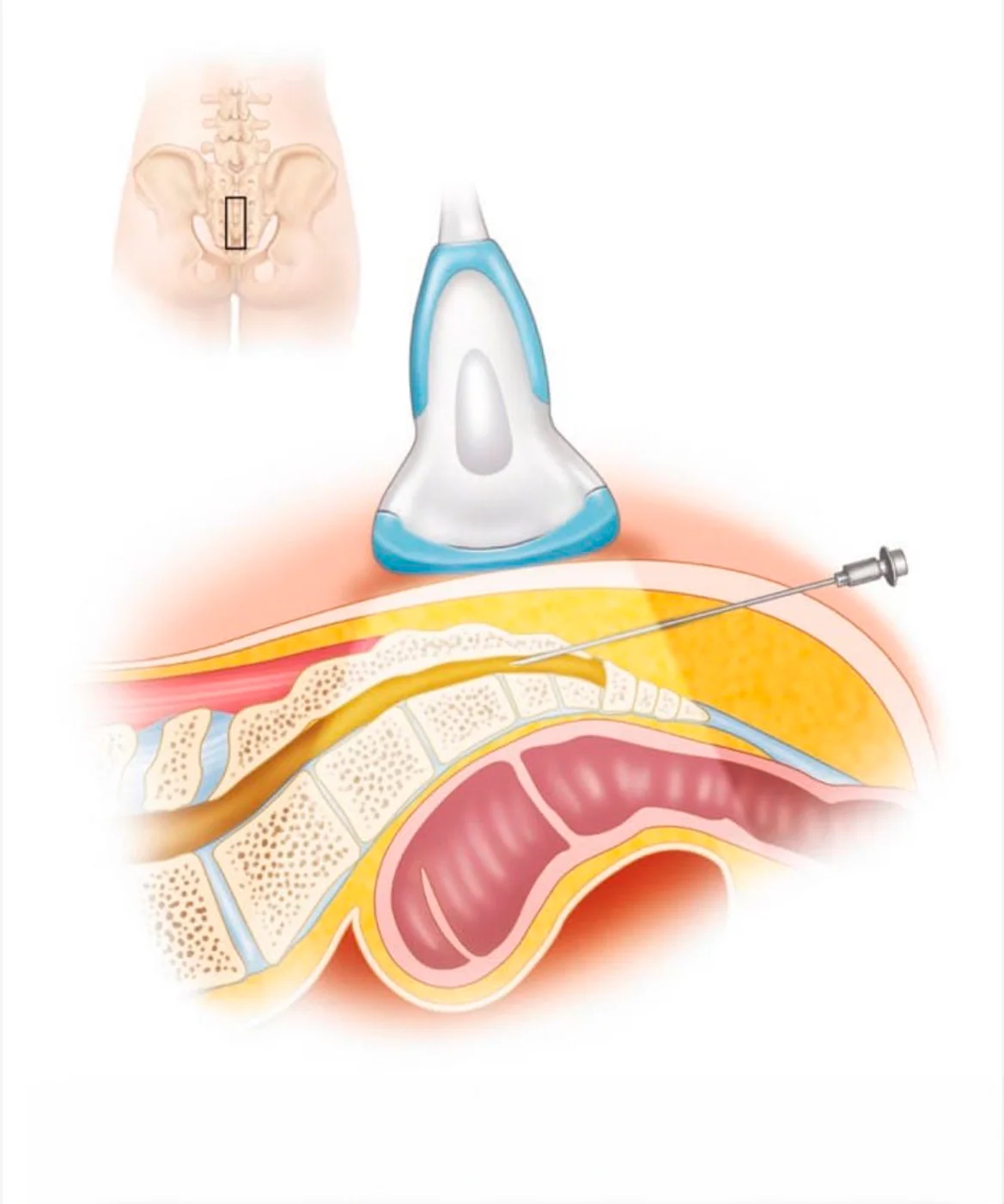 bloqueo epidural caudal ecoguiado